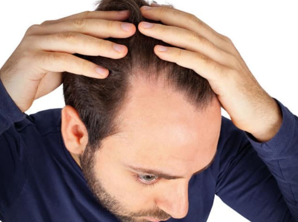 ¿Cuánto cuesta un implante de cabello en México?