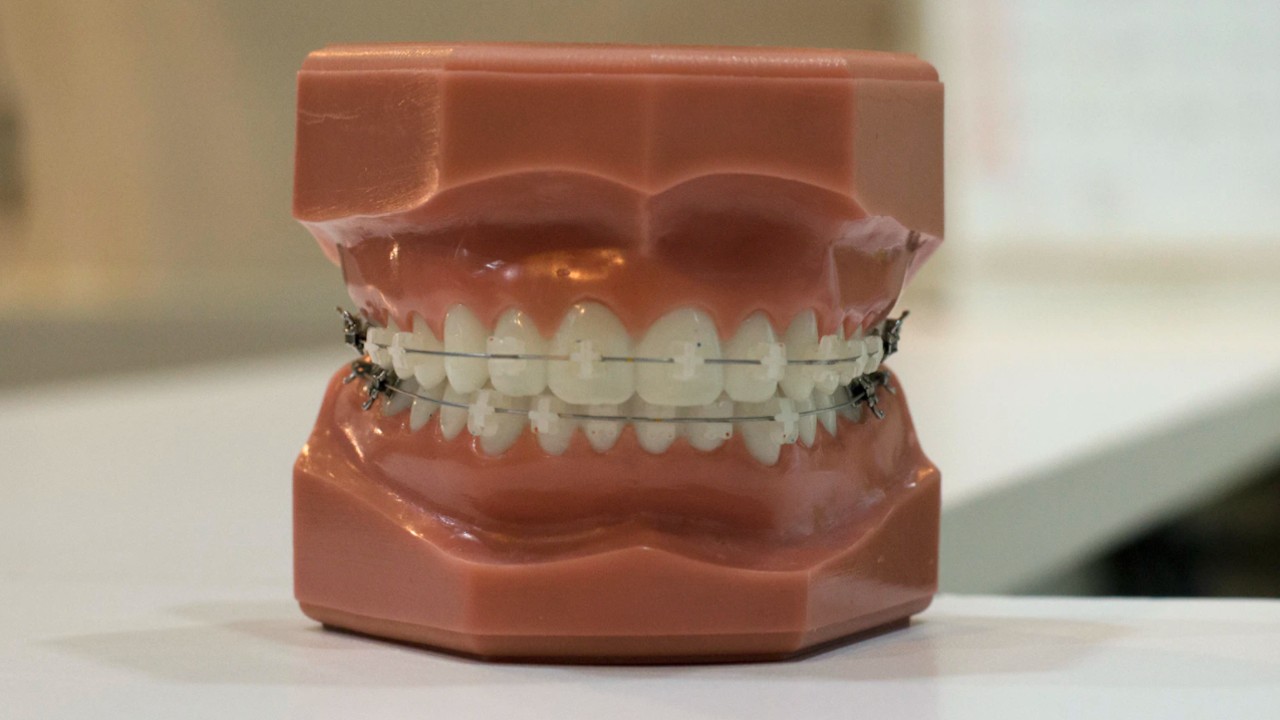 ¿Cuánto cuesta ponerse brackets en México?