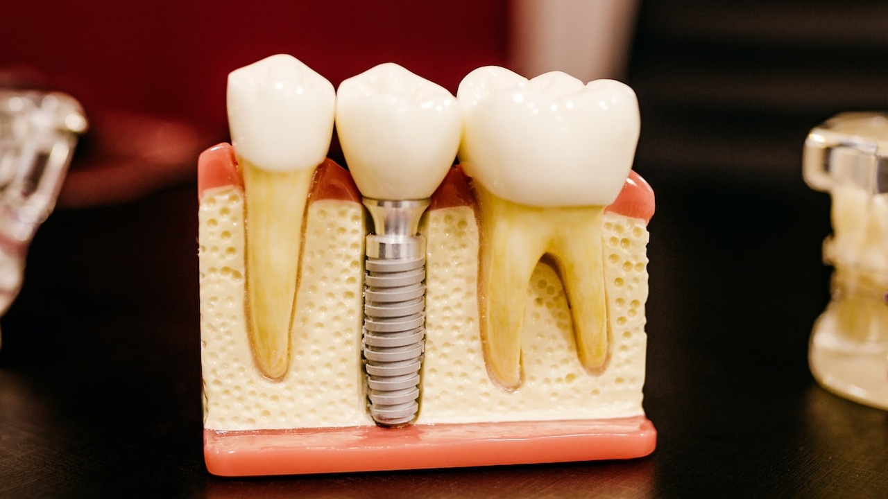 ¿Quieres ir al DENTISTA sin COSTO en el IMSS? Así lo puedes hacer